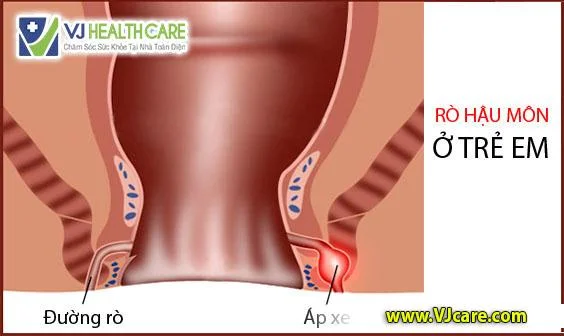 rò hậu môn ở trẻ em - ro hau mon o tre em ASIA Health